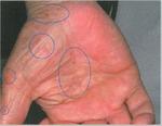 疥癬の症状　Symptom of mange2